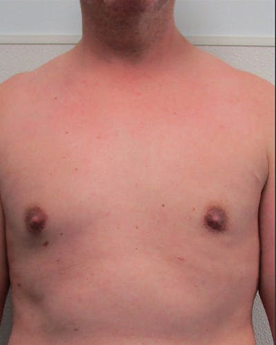 Liposuction Before & After Gallery - Patient 178098 - Image 2