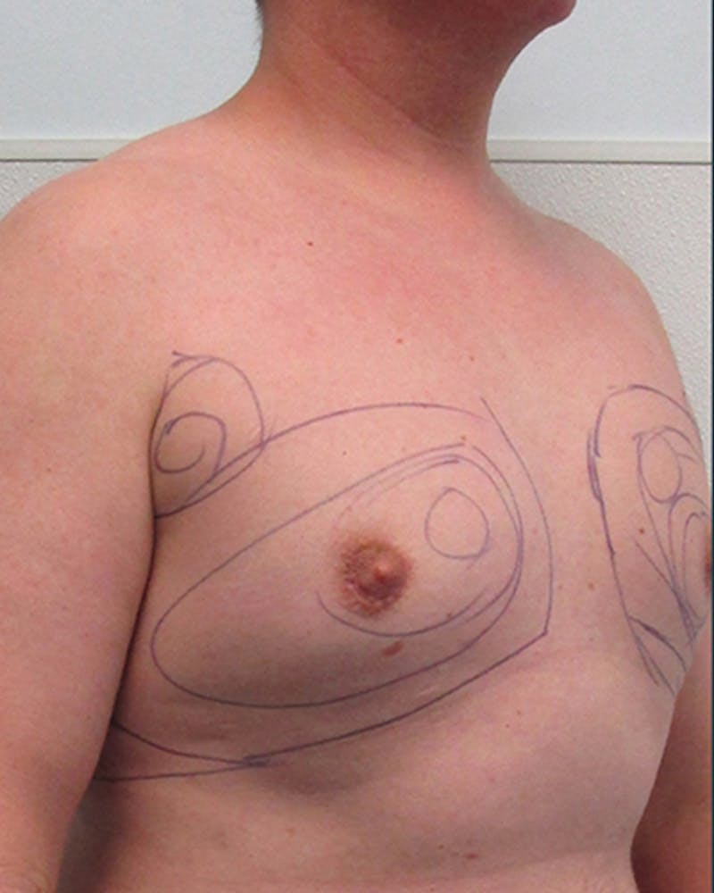 Liposuction Before & After Gallery - Patient 178098 - Image 3