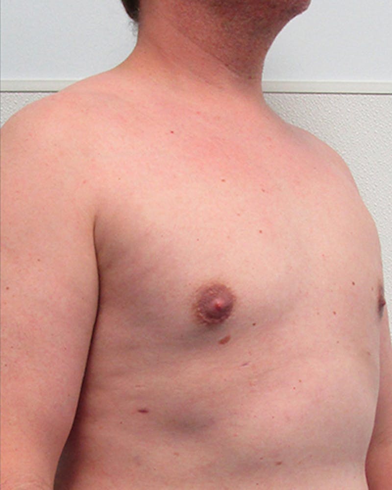 Liposuction Before & After Gallery - Patient 178098 - Image 4