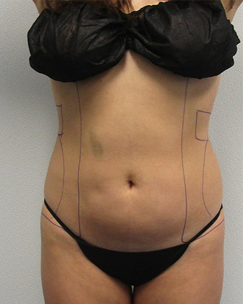 Liposuction Before & After Gallery - Patient 151118 - Image 1