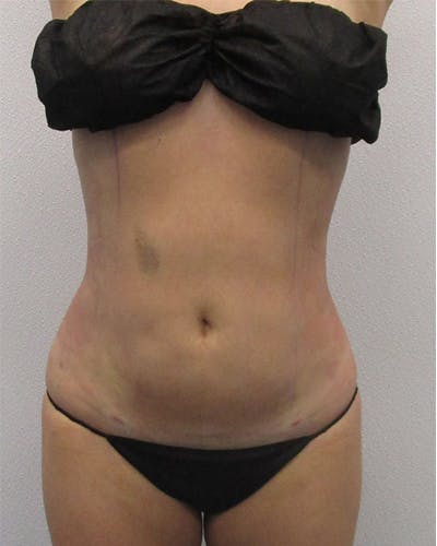 Liposuction Before & After Gallery - Patient 151118 - Image 2