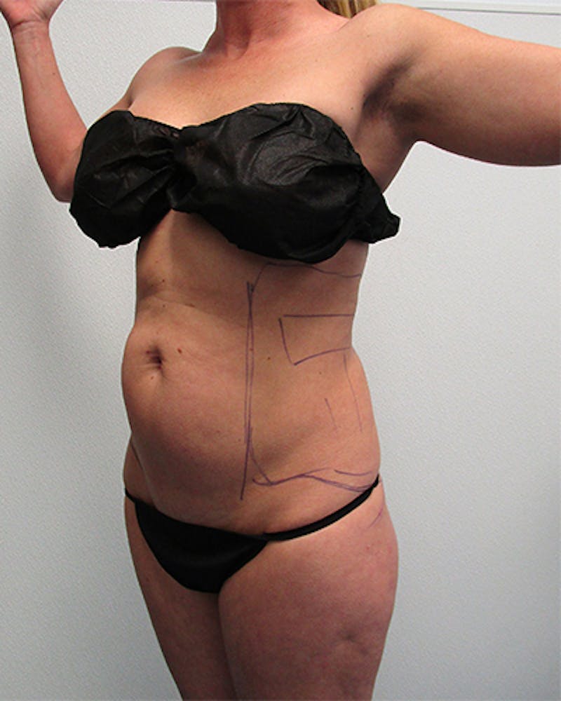 Liposuction Before & After Gallery - Patient 521975 - Image 1