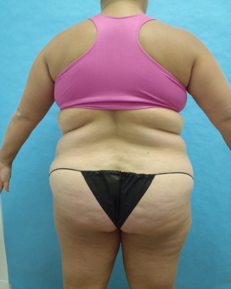 Liposuction Before & After Gallery - Patient 318161 - Image 1
