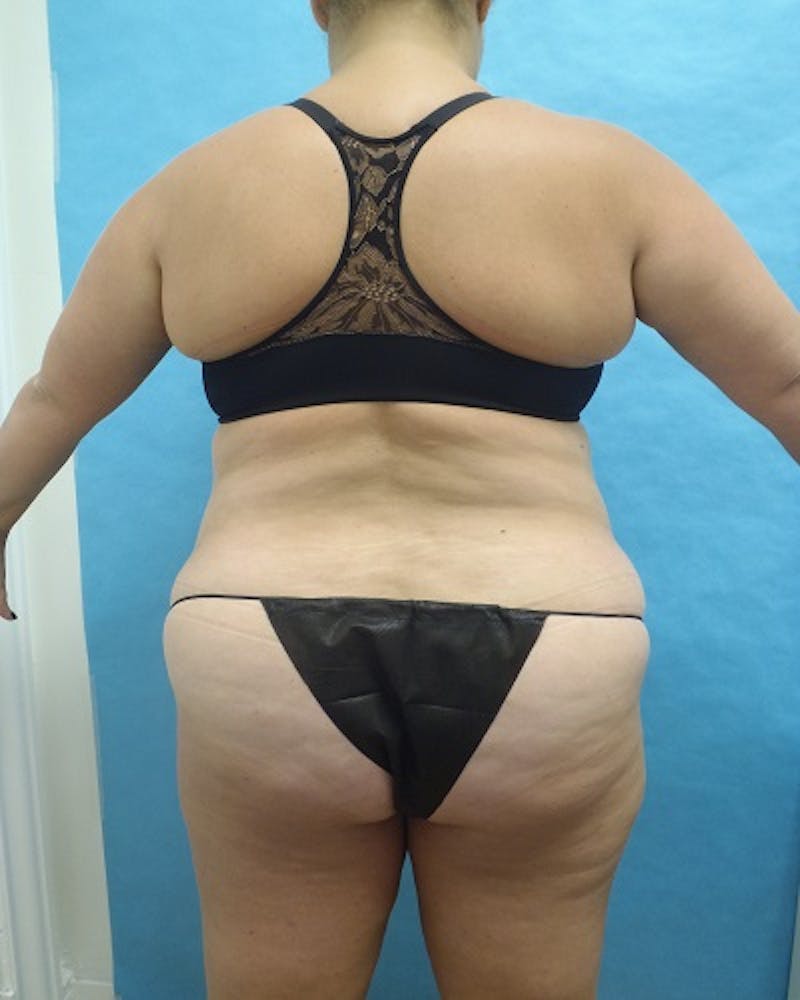 Liposuction Before & After Gallery - Patient 318161 - Image 2