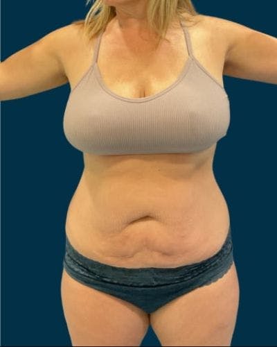 Tummy Tuck Before & After Gallery - Patient 270079 - Image 1