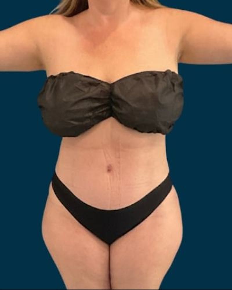 Tummy Tuck Before & After Gallery - Patient 270079 - Image 2