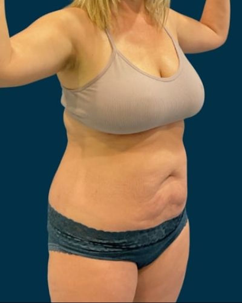 Tummy Tuck Before & After Gallery - Patient 270079 - Image 3