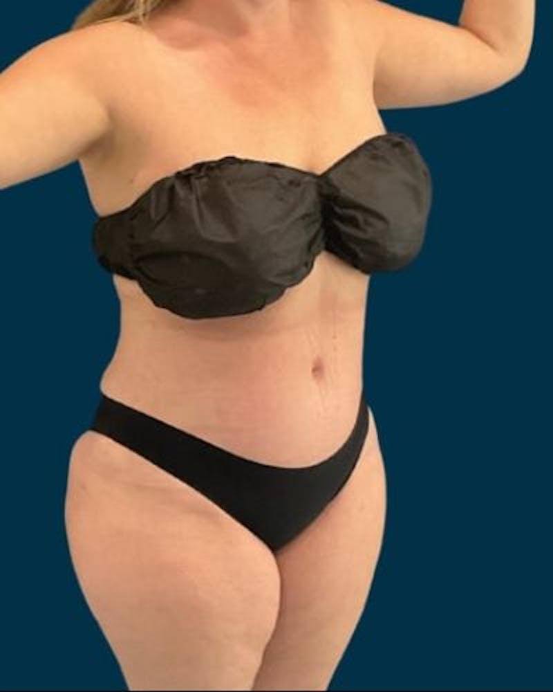 Tummy Tuck Before & After Gallery - Patient 270079 - Image 4