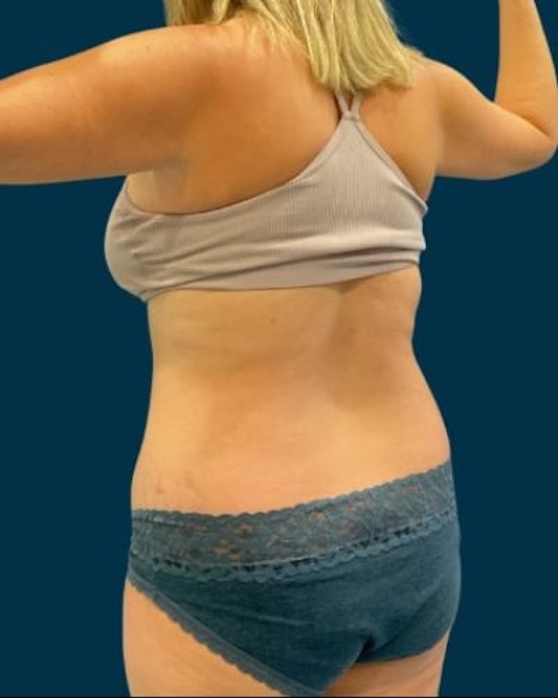 Tummy Tuck Before & After Gallery - Patient 270079 - Image 5