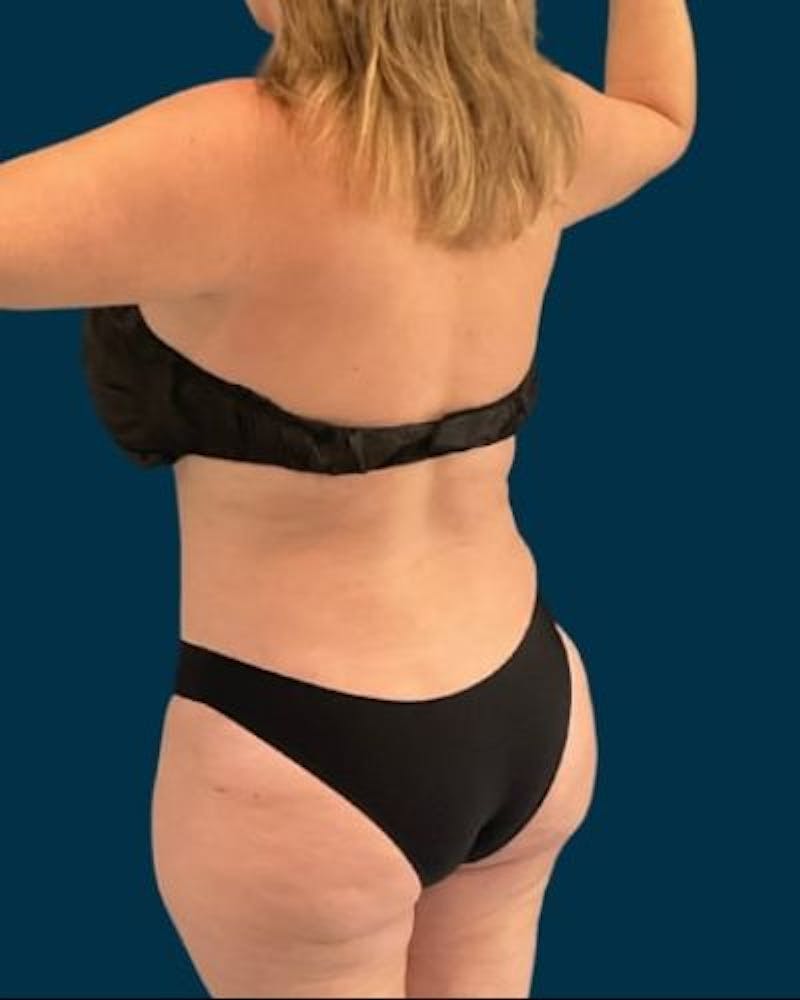 Tummy Tuck Before & After Gallery - Patient 270079 - Image 6