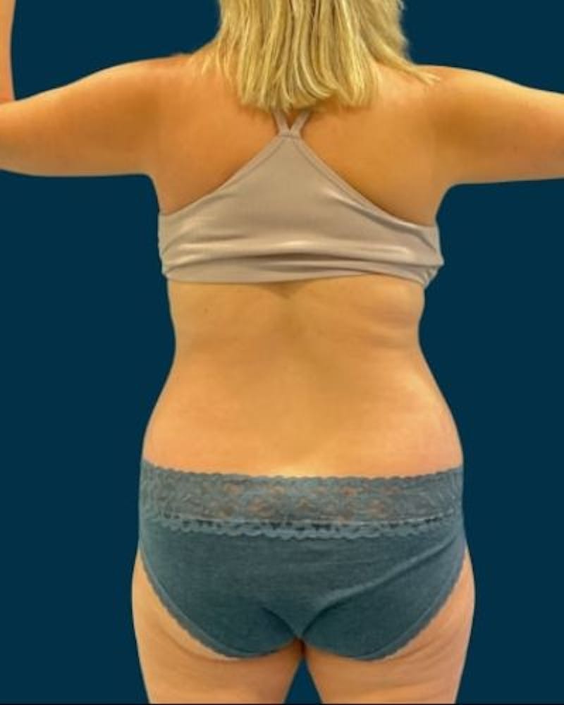 Tummy Tuck Before & After Gallery - Patient 270079 - Image 7