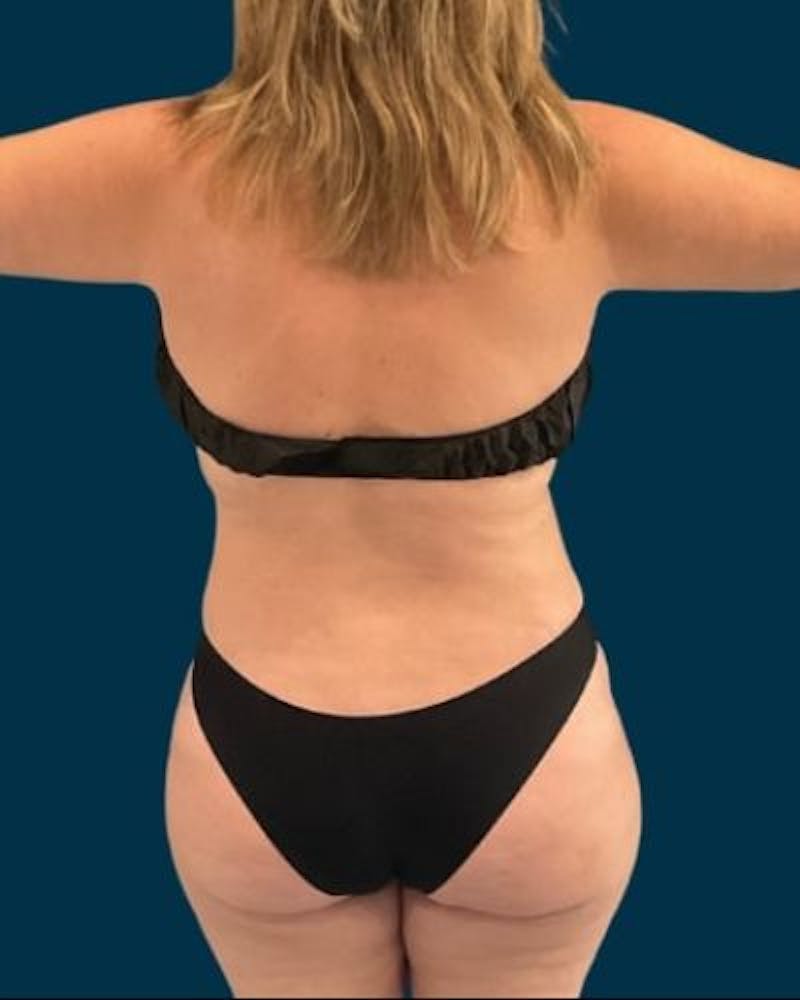 Tummy Tuck Before & After Gallery - Patient 270079 - Image 8