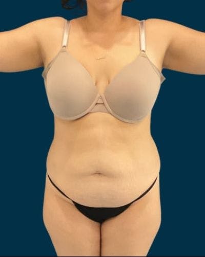Tummy Tuck Before & After Gallery - Patient 221763 - Image 1