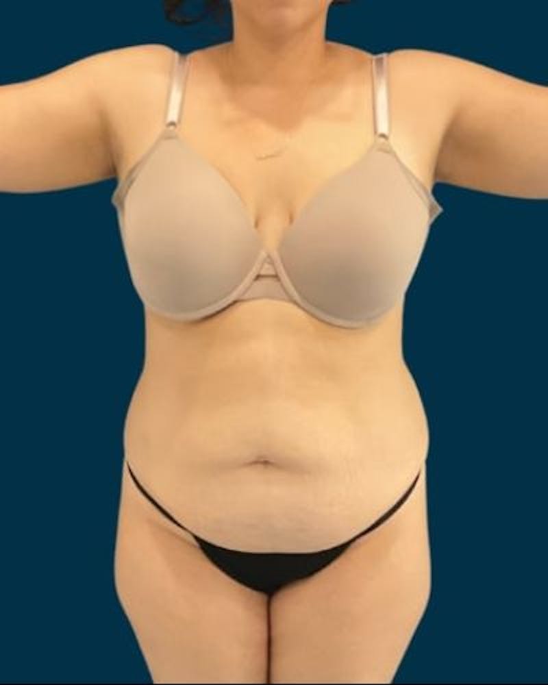 Tummy Tuck Before & After Gallery - Patient 221763 - Image 1