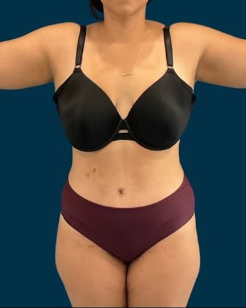 Tummy Tuck Before & After Gallery - Patient 221763 - Image 2