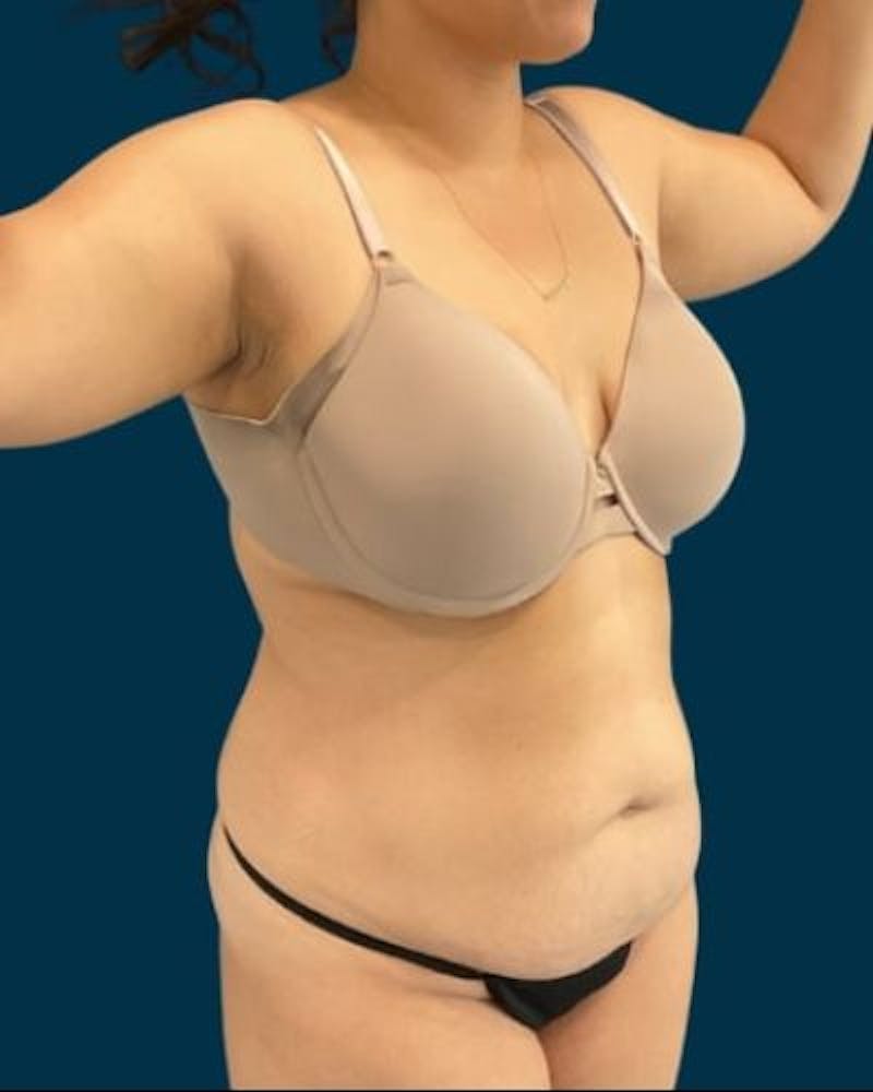 Tummy Tuck Before & After Gallery - Patient 221763 - Image 3