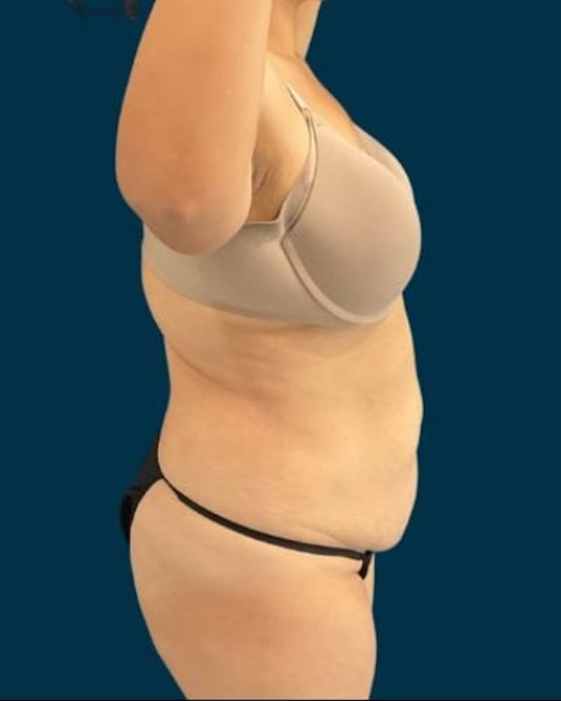 Tummy Tuck Before & After Gallery - Patient 221763 - Image 5