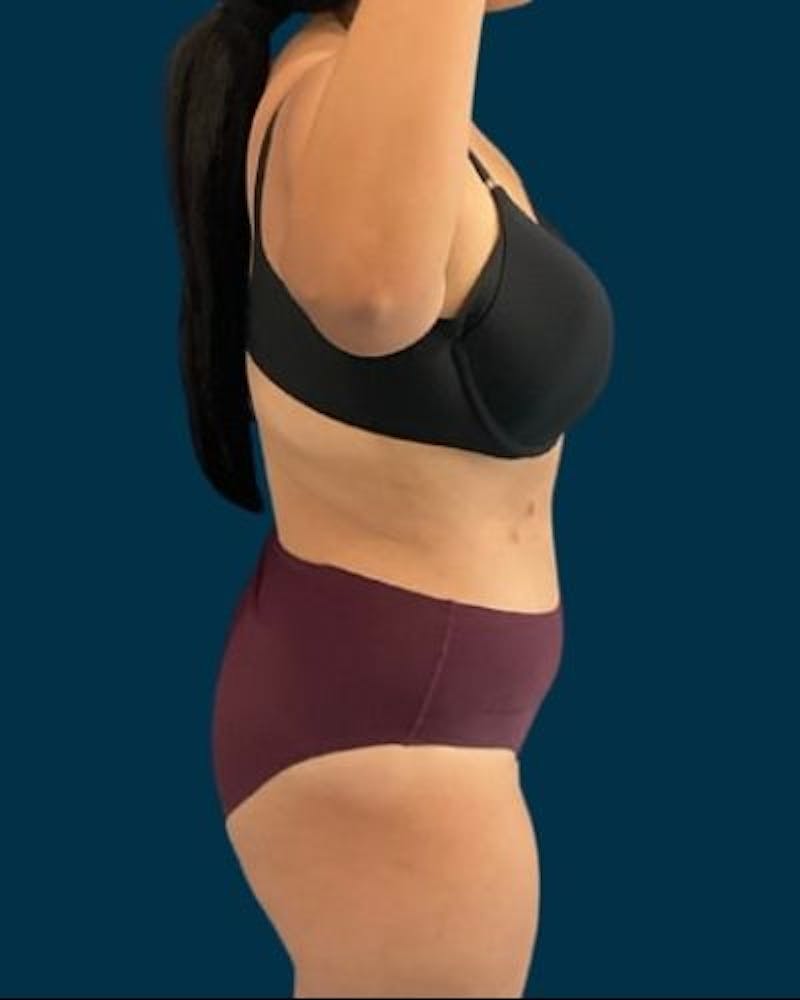 Tummy Tuck Before & After Gallery - Patient 221763 - Image 6