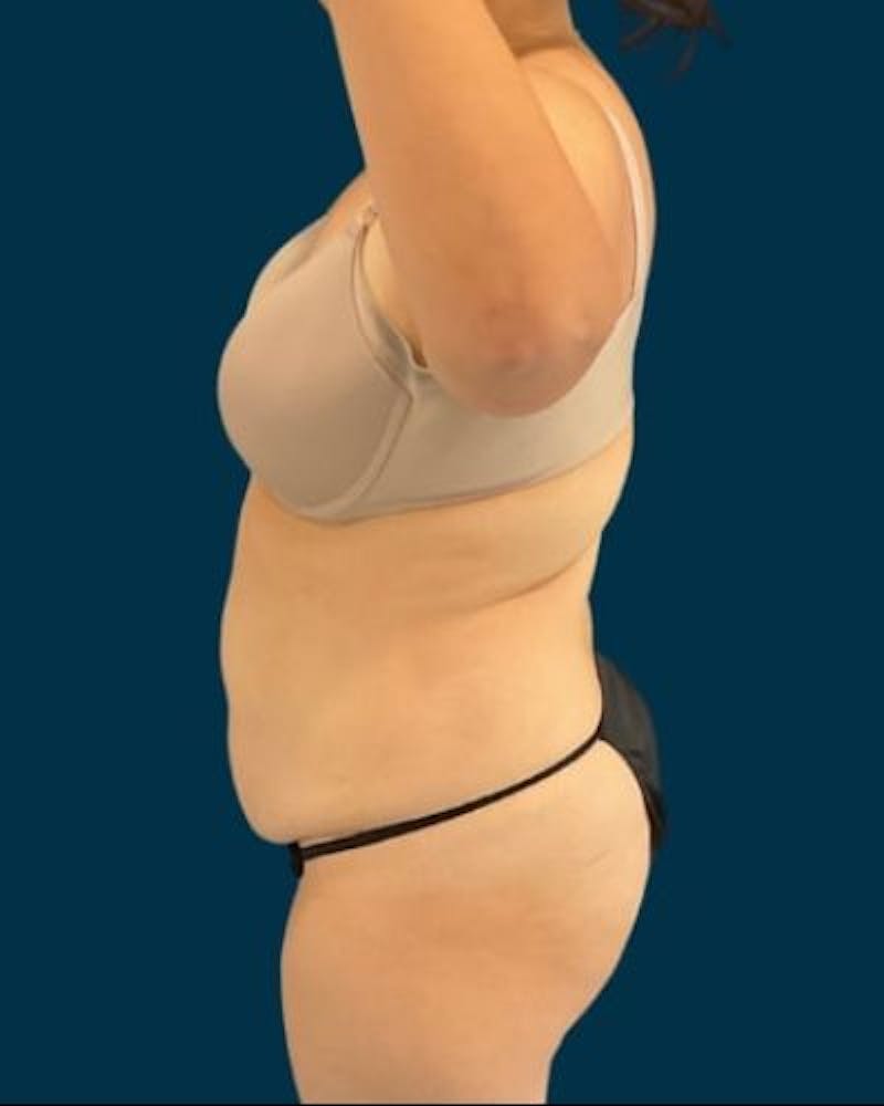 Tummy Tuck Before & After Gallery - Patient 221763 - Image 7