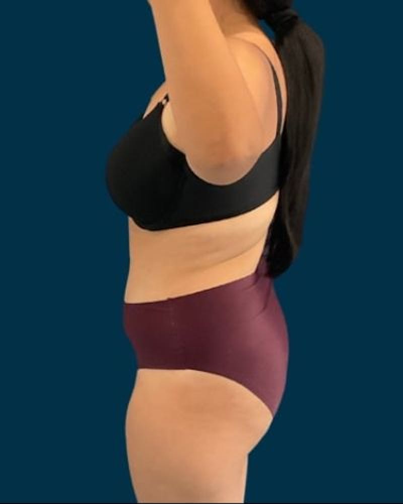 Tummy Tuck Before & After Gallery - Patient 221763 - Image 8