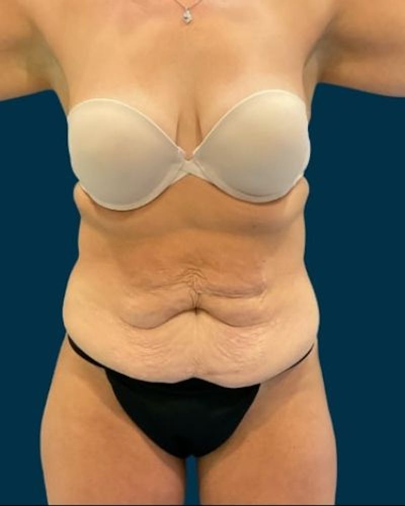 Tummy Tuck Before & After Gallery - Patient 244347 - Image 1
