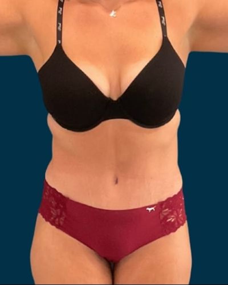 Tummy Tuck Before & After Gallery - Patient 244347 - Image 2
