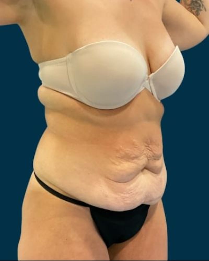 Tummy Tuck Before & After Gallery - Patient 244347 - Image 3
