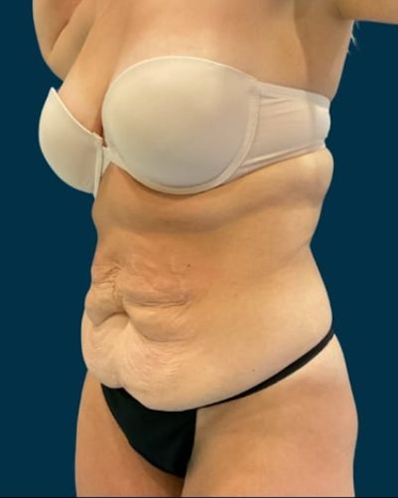 Tummy Tuck Before & After Gallery - Patient 244347 - Image 5