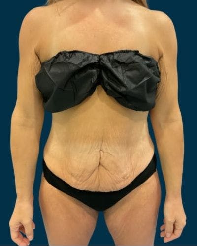 Tummy Tuck Before & After Gallery - Patient 307376 - Image 1