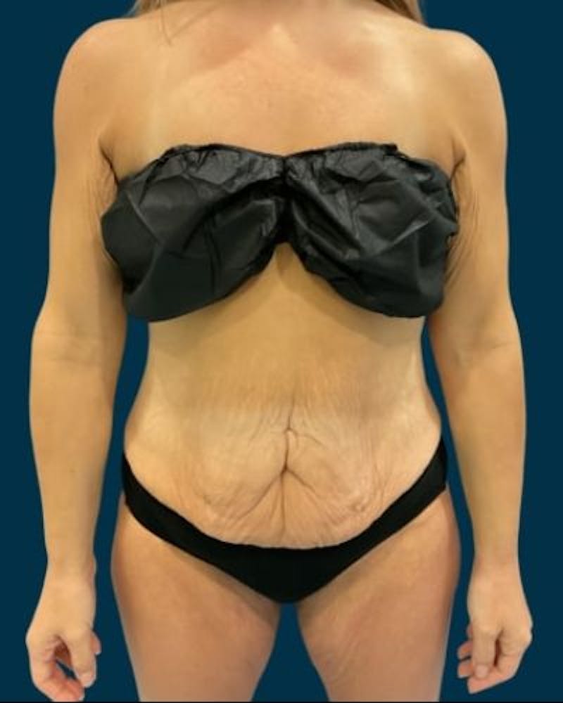 Tummy Tuck Before & After Gallery - Patient 307376 - Image 1