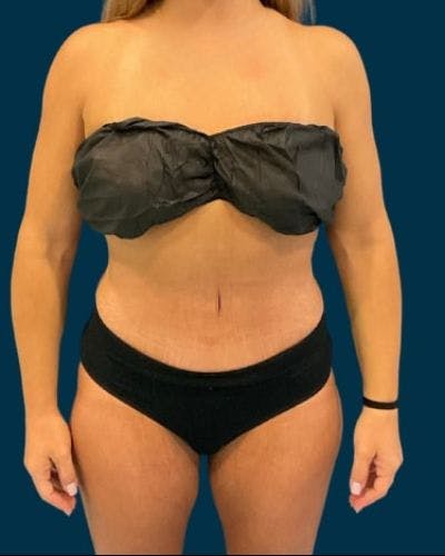 Tummy Tuck Before & After Gallery - Patient 307376 - Image 2