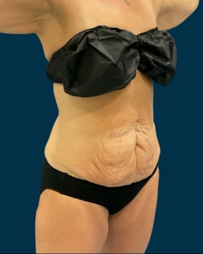 Tummy Tuck Before & After Gallery - Patient 307376 - Image 3