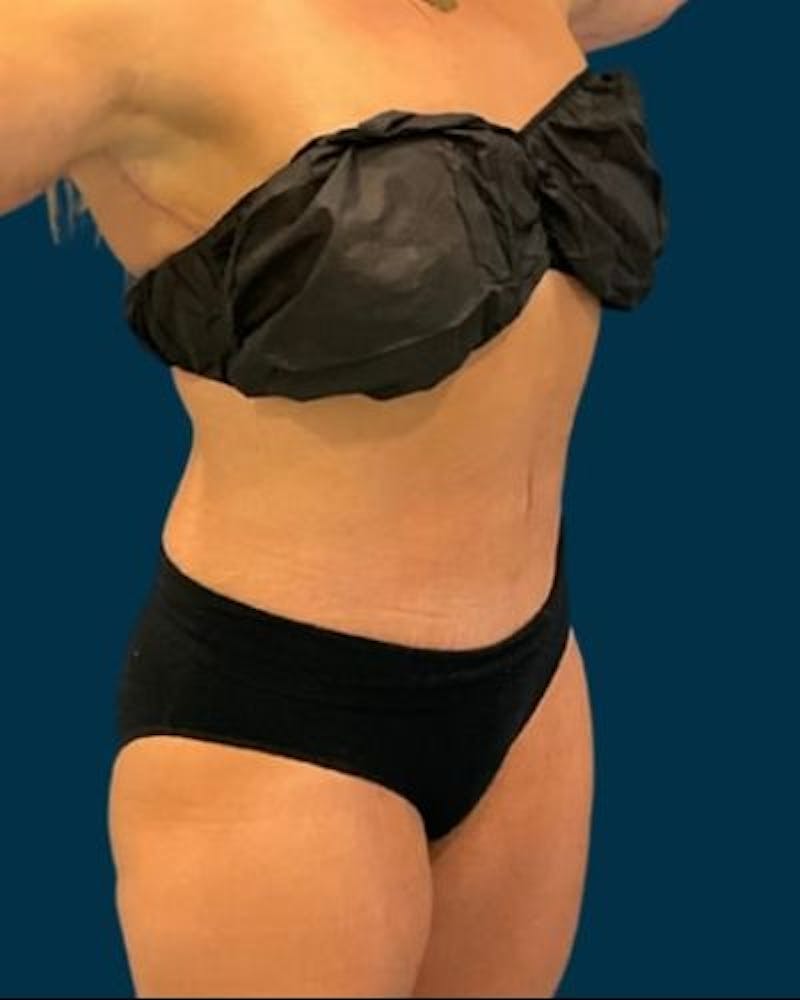Tummy Tuck Before & After Gallery - Patient 307376 - Image 4