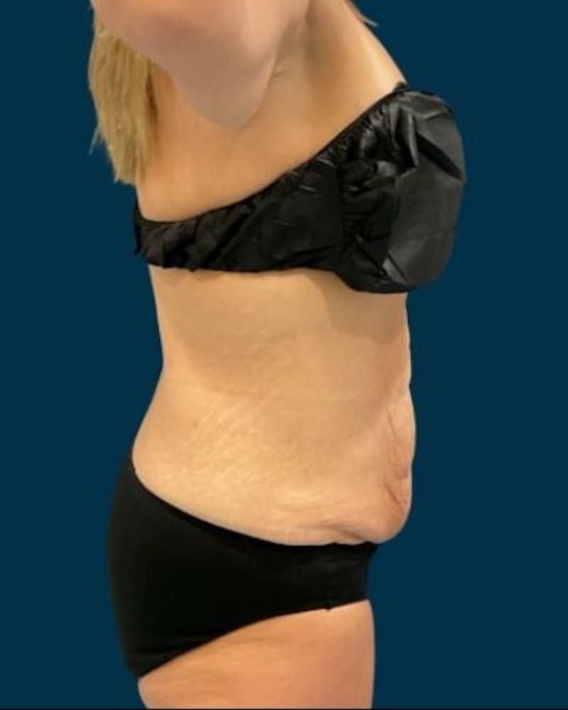 Tummy Tuck Before & After Gallery - Patient 307376 - Image 5