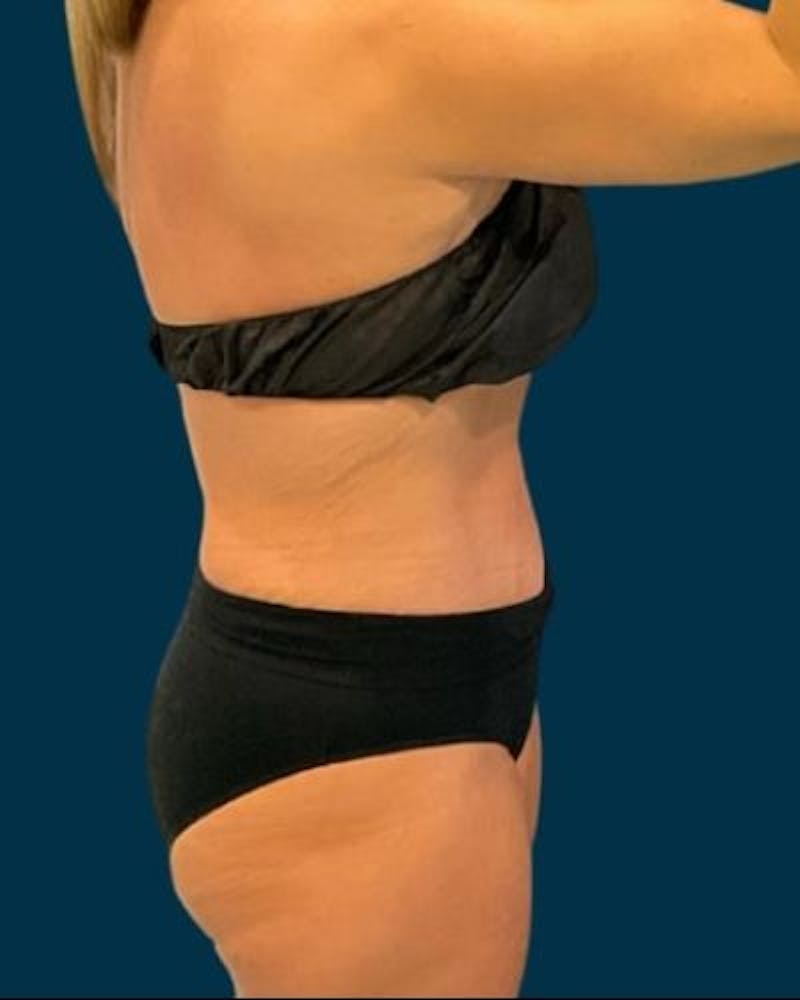 Tummy Tuck Before & After Gallery - Patient 307376 - Image 6