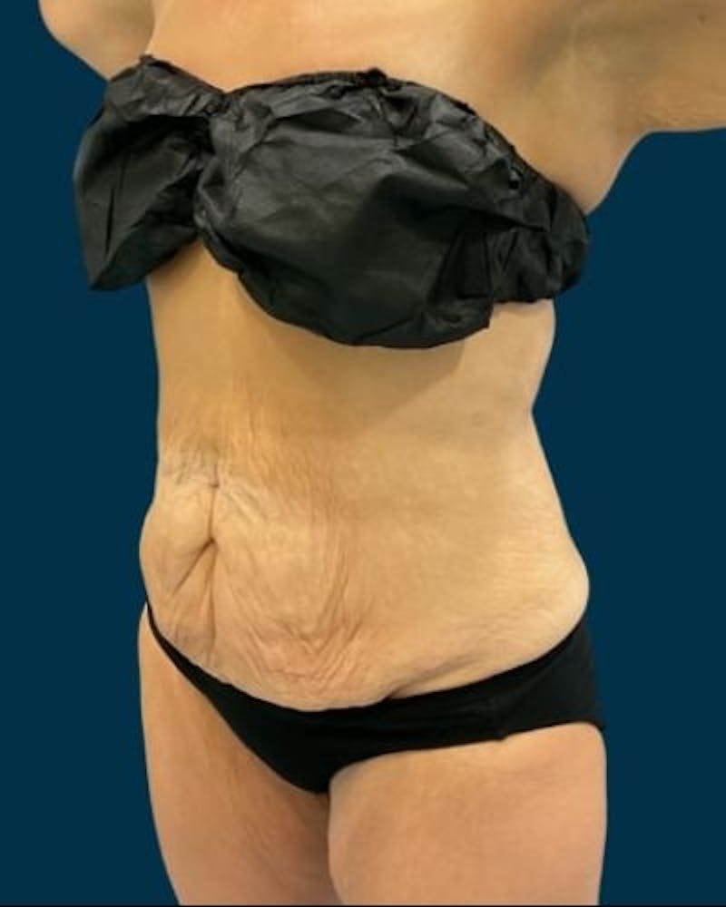 Tummy Tuck Before & After Gallery - Patient 307376 - Image 7