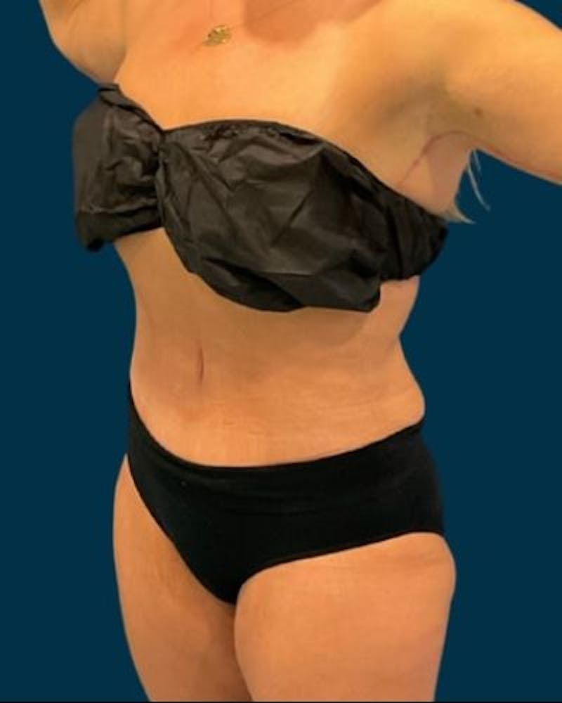 Tummy Tuck Before & After Gallery - Patient 307376 - Image 8