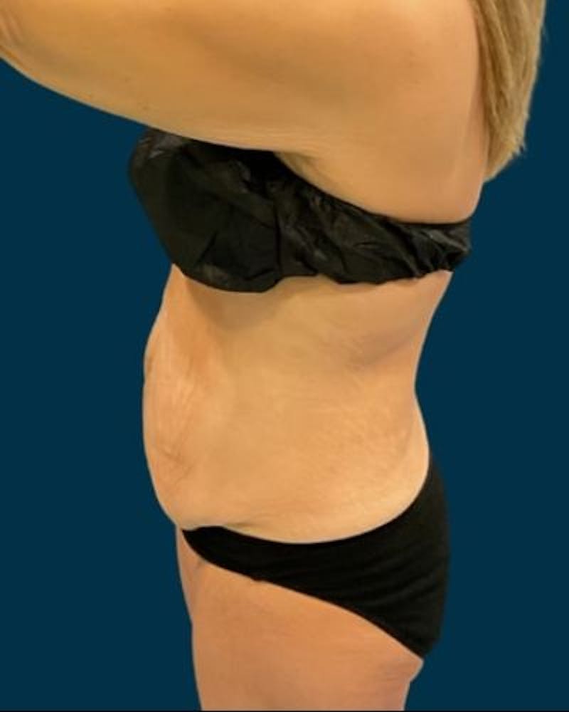 Tummy Tuck Before & After Gallery - Patient 307376 - Image 9