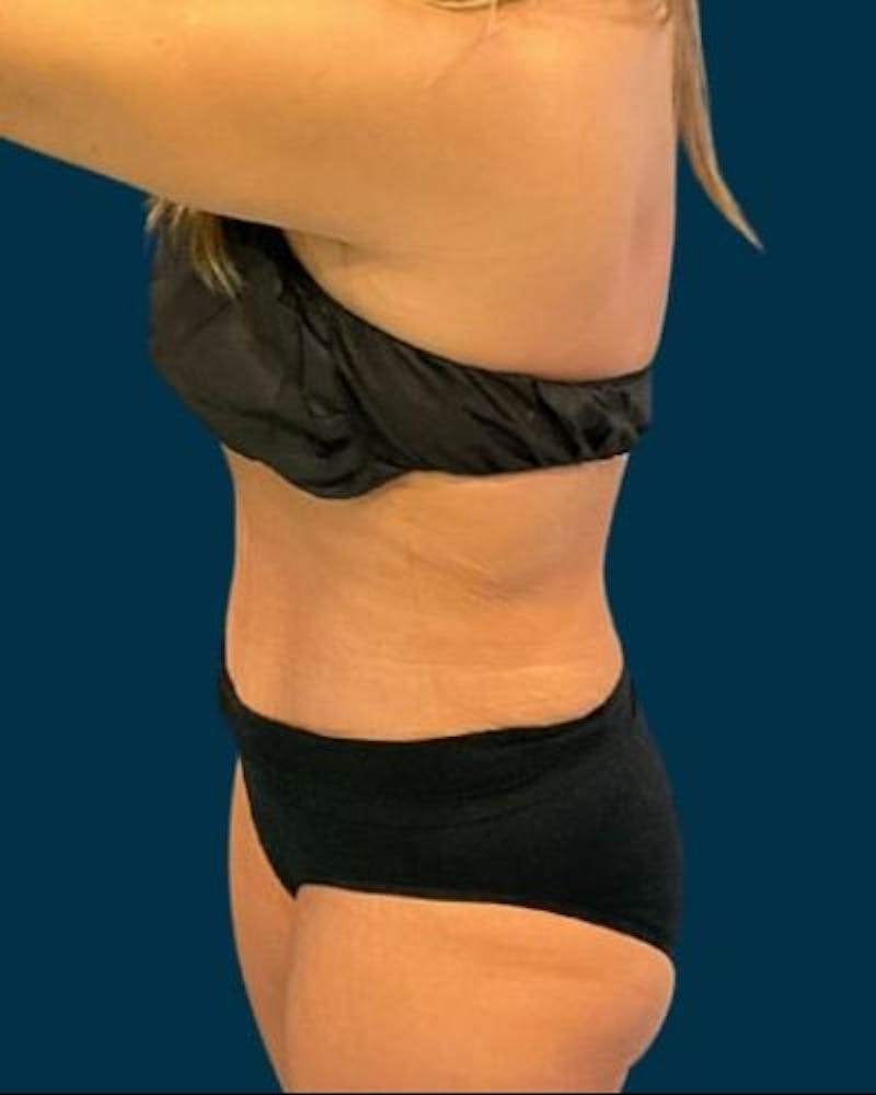 Tummy Tuck Before & After Gallery - Patient 307376 - Image 10