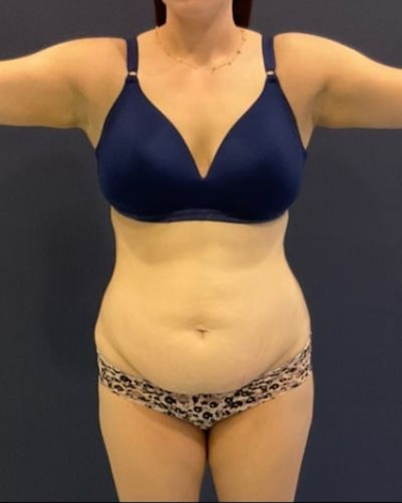 Tummy Tuck Before & After Gallery - Patient 746168 - Image 1