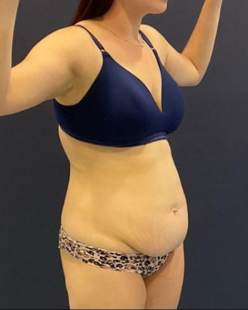 Tummy Tuck Before & After Gallery - Patient 746168 - Image 3