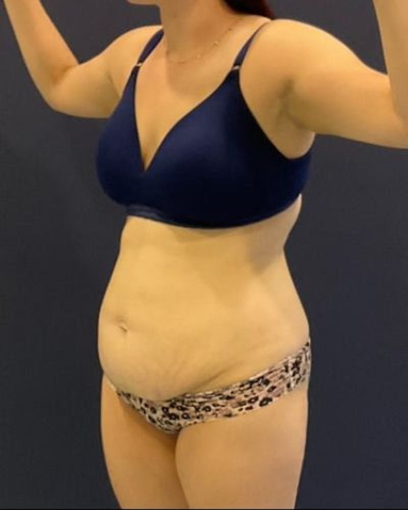 Tummy Tuck Before & After Gallery - Patient 746168 - Image 5