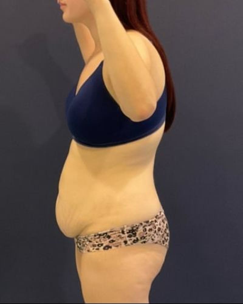 Tummy Tuck Before & After Gallery - Patient 746168 - Image 7
