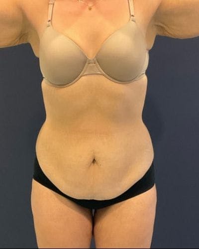 Tummy Tuck Before & After Gallery - Patient 391483 - Image 1