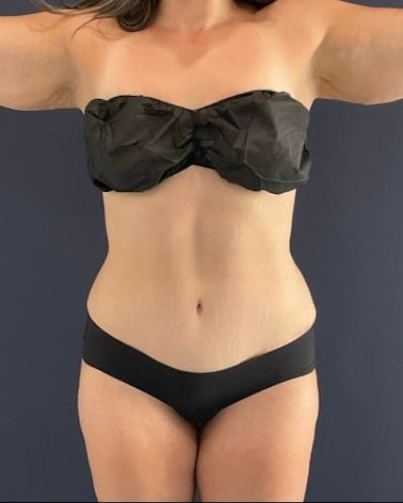 Tummy Tuck Before & After Gallery - Patient 391483 - Image 2