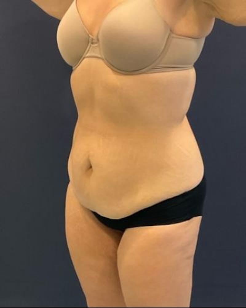 Tummy Tuck Before & After Gallery - Patient 391483 - Image 3