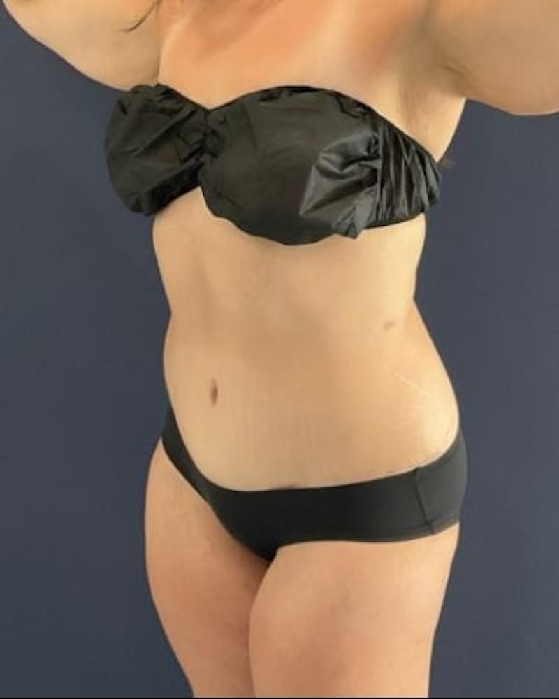 Tummy Tuck Before & After Gallery - Patient 391483 - Image 4