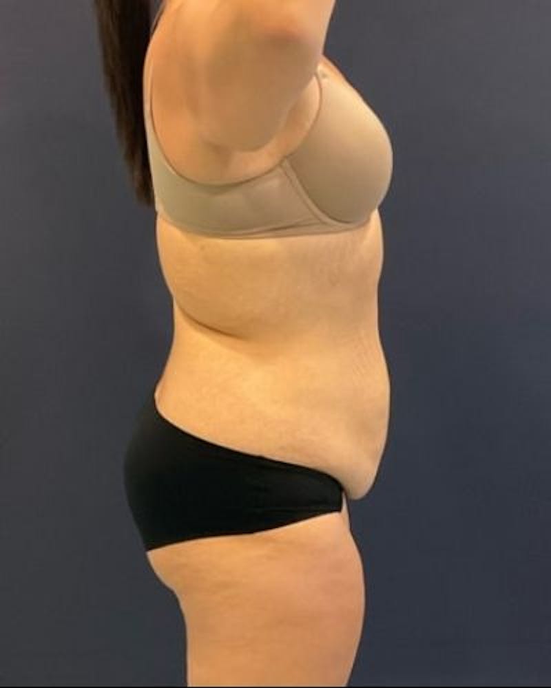 Tummy Tuck Before & After Gallery - Patient 391483 - Image 5