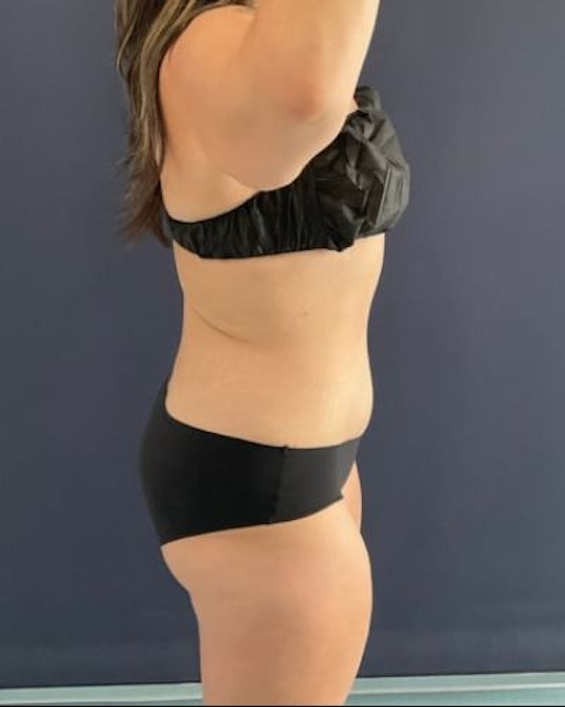 Tummy Tuck Before & After Gallery - Patient 391483 - Image 6