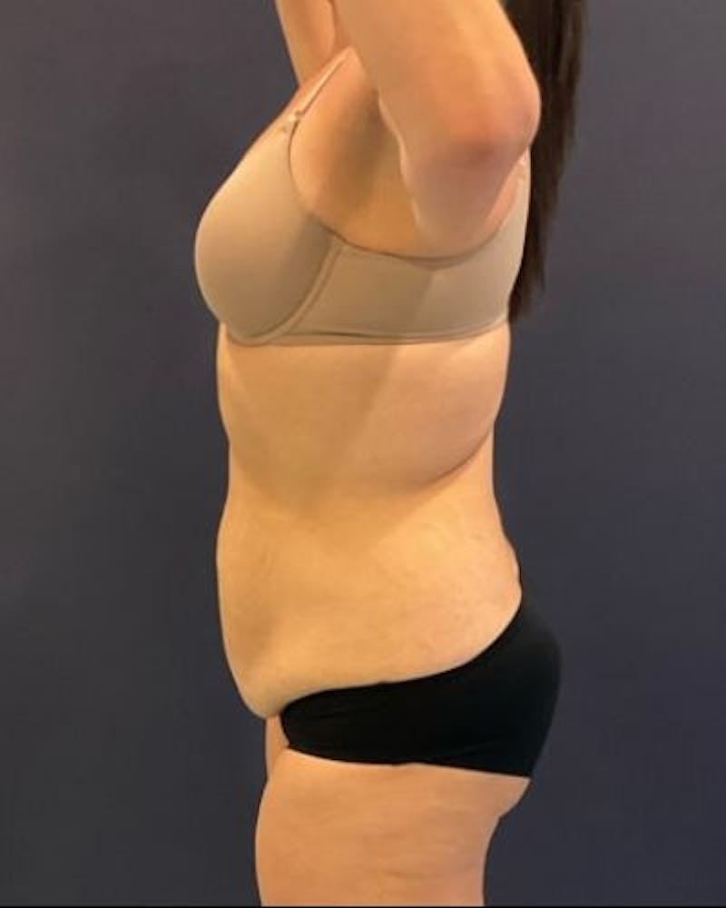 Tummy Tuck Before & After Gallery - Patient 391483 - Image 7
